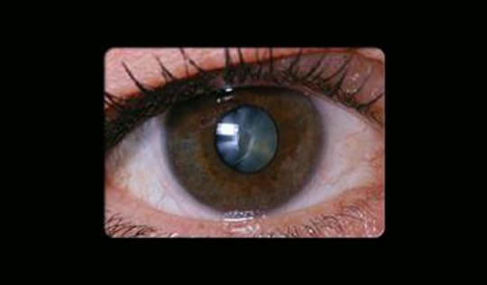 Intra-Ocular-Lens